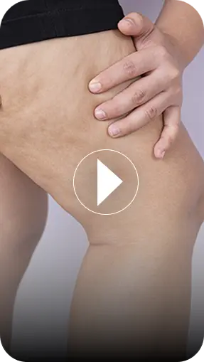 Lipedema